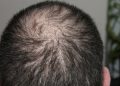 5 dingen die u leert als u een haartransplantatie hebt ondergaan
